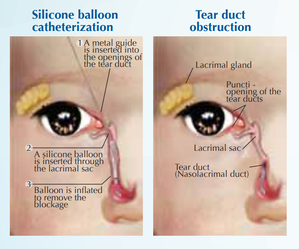 Congenital tear duct obstruction washout and probing